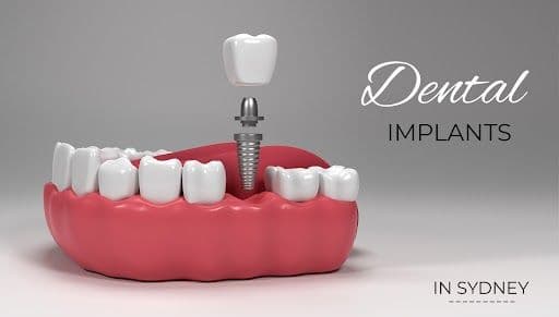 Dental Implant Cost Sydney for Single vs Full Mouth